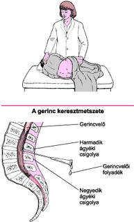 Refluxbetegség gyermekkorban