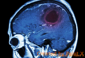 az agy rosszindulatú daganata