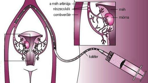 fogyás a méh mióma embolizációja után