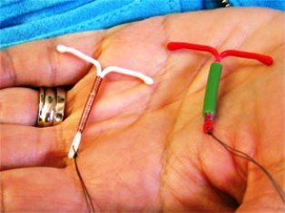 lehetséges-e visszérrel elhelyezni az IUD-t fül a visszerek esetén