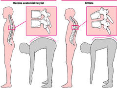 a vállízület osteochondrosisának otthoni kezelése