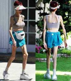 fogyás anorexiás férfi test karcsúsító tartály tetejét