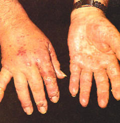 bőrbetegség kézen)