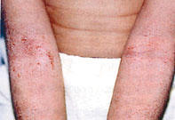 Pityriasis formái - Jellemző bőrtünet a finom hámlás
