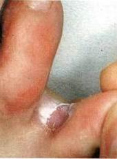 a lábujjak közötti bőr nedves lesz hpv természetes kiegészítő kezelés