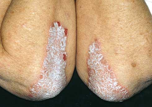 Pikkelysömörös (psoriasis) bőr kozmetikai kezelése - Dermatica