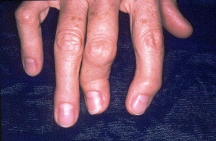 Arthritis psoriatica tünetei és kezelése