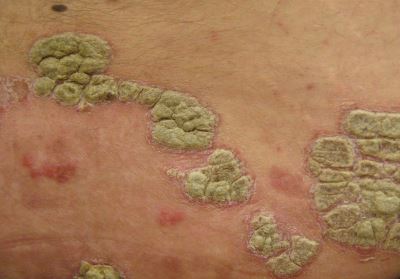 pikkelysömör vagy lichen planus kezelés