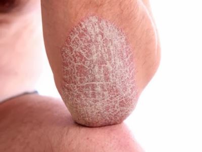 Pikkelysömör (pszoriázis, psoriasis) tünetei és kezelése - HáziPatika