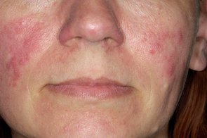 rosacea diétája)