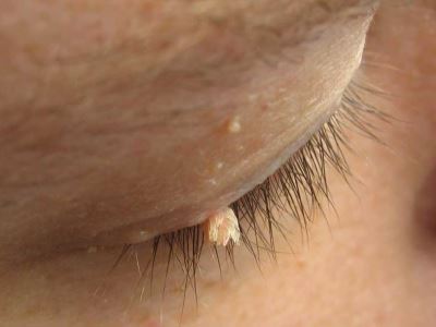 Papillómák a gyermek arcán: okai, tünetei és kezelése - Myoma