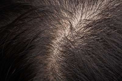 A diffúz hajhullás okai és kezelése Kopaszság, magas vérnyomás