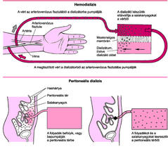 peritonealis rák alternatív kezelés)