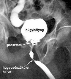 a betegség prosztata okairól a prosztatitis kezelésének kezelése