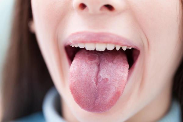 száraz nyelvszag a szájból