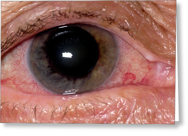 A zöld hályog (glaucoma) és tünetei