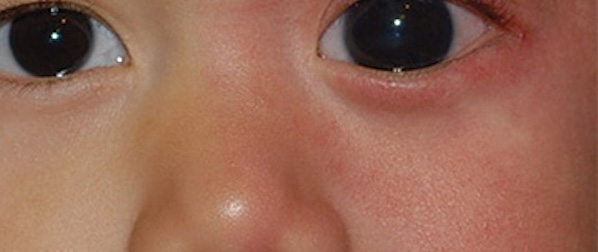szem látás betegség szürkehályog glaukóma