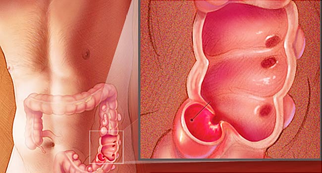 Hogy lehet diagnosztizálni az IBS-t?