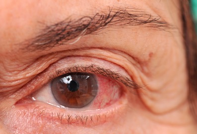 Látásélesség a glaukóma 3. fokozatában. A glaukóma oka