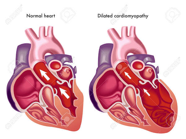 szívbetegség tünetei és egészségügyi hatásai