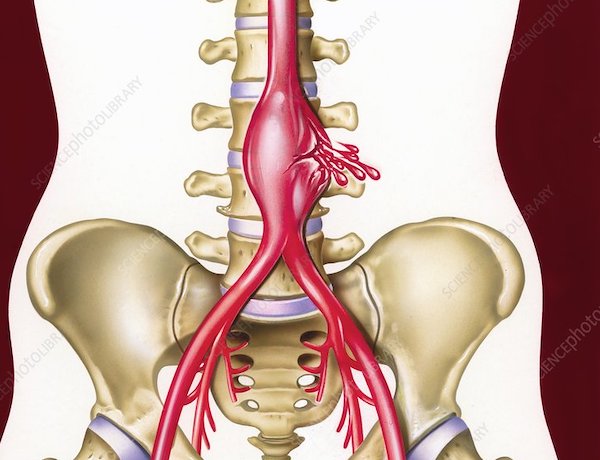 Magyar Nemzeti Szívalapítvány - Érbetegségek - Aorta aneurysma (tágulat)