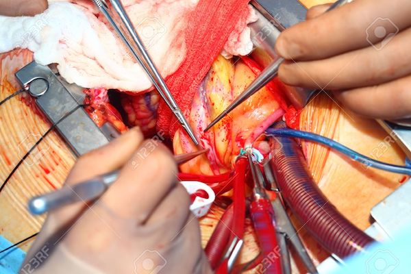 szív-egészségügyi angioplasztika