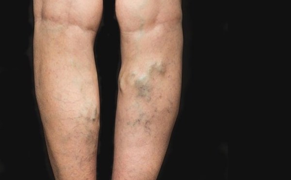 hogyan lehet felismerni a visszerek a lábakon fotó visszér súlyosbodása mit kell tenni