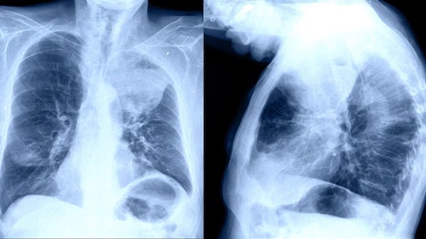 Lehet-e a vállfájdalom a tüdőrák tünete?