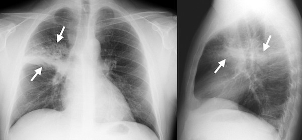 A tüdőgyulladás kialakulása és rizikófaktorai