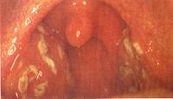 eltávolítása mandulák fogyni a csípő zsírvesztése egy hét alatt