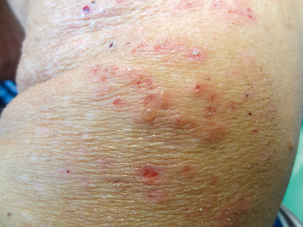 viszketéssel járó bőrbetegségek betegség vörös foltok a testen és viszketés