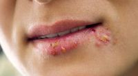 bullous pemphigoid betegség)