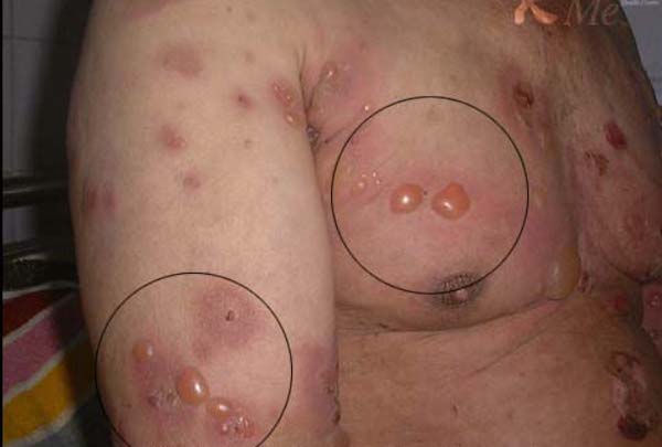 Autoimmun hólyagos bőrbetegségek: Pemphigus és más kórképek