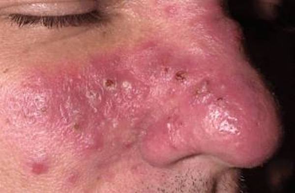 Rosacea diétája