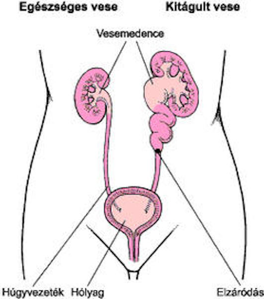 magas vérnyomás vese hidronephrosisával)