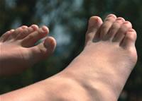 A lábak visszértágulatával sokat járhat Tehet a duzzadó lábak ellen | DUOL