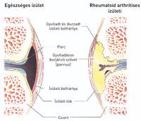 az ízületek ízületeinek izomkárosodása