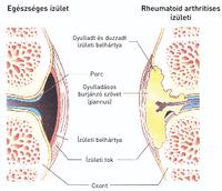 ízületek ízületi gyulladása m 16)